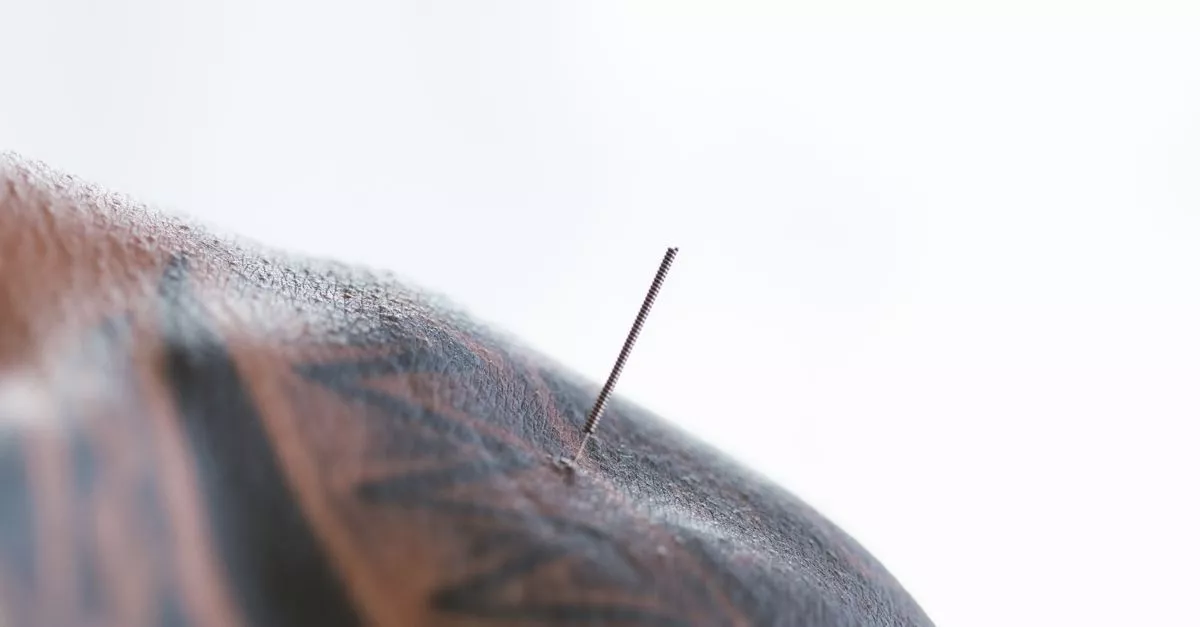 A Point Acupuncture